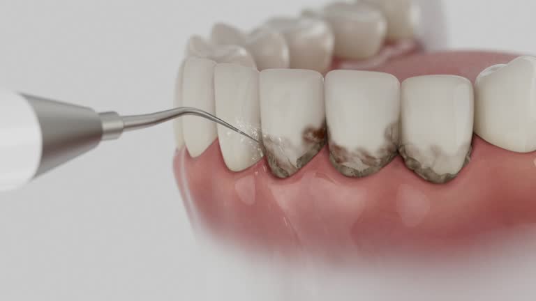 Reliable Dental Implants contractor in Milaca, MN by Smile Center Dentistry